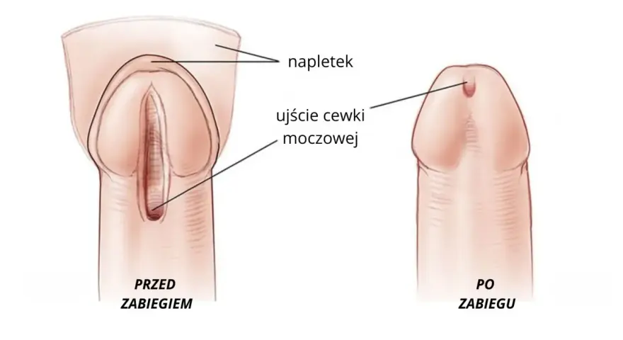 Ilustracja porównująca cewkę moczową przed i po zabiegu, z zaznaczonym napletkiem i ujściem cewki.