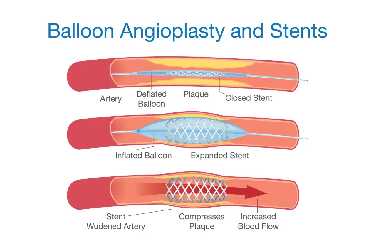 Ilustracja przedstawia zabieg PCI kardiologia: balonik rozprężający stent w zwężonej tętnicy, poprawiający przepływ krwi.